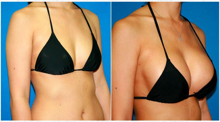 Antes e depois de aumento de mama com cirurgia plástica