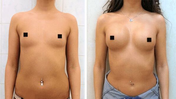 fotos antes e depois do aumento cirúrgico dos seios