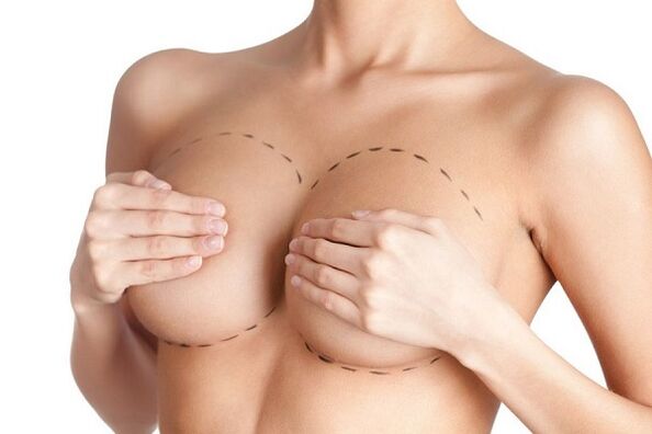 marcação para cirurgia de aumento de mama