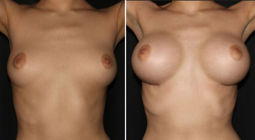 Antes e depois da cirurgia de aumento de mama